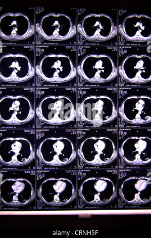 Cat scan della corteccia cerebrale Foto Stock