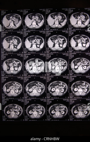 Cat scan della corteccia cerebrale Foto Stock