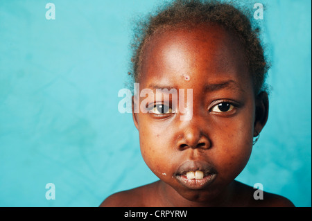 Un 12 anni ragazza affetti da sindrome nefrosica e anemia falciforme. Foto Stock