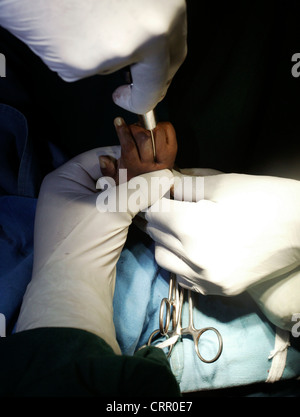 La mano del bambino con la sindrome di catrame che subisce un intervento chirurgico. Foto Stock