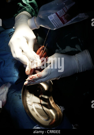 La mano del bambino con la sindrome di catrame che subisce un intervento chirurgico. Foto Stock