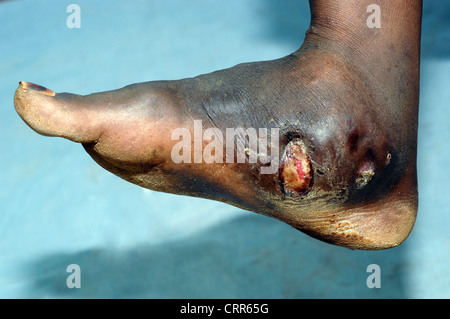 Actinomycetoma su un piede di pazienti Foto Stock