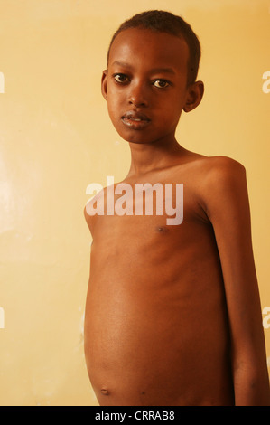 Un bambino con un torace deformato Foto Stock