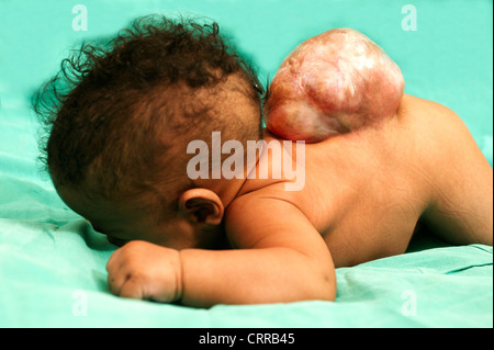 La spina dorsale di un bambino maschio di 5 mesi con Meningomyocele; un tumore congenita del canale vertebrale. Foto Stock