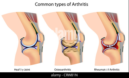 I tipi più comuni di artrite: osteoartrite ed artrite reumatoide dell'articolazione del ginocchio Foto Stock