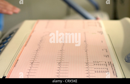 Un elettrocardiogramma registrazione dei pazienti un ciclo cardiaco prodotta da un elettrocardiografo Foto Stock