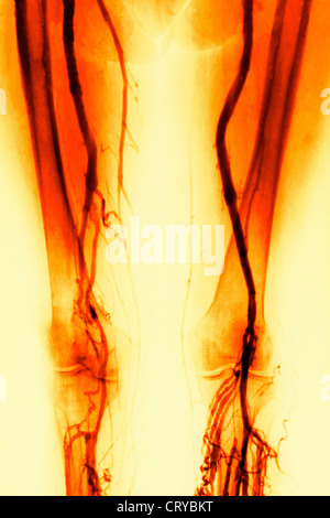 Vena THOMBOSED, angiografia Foto Stock