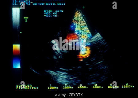 Endocardite infettiva, SONOGR. Foto Stock