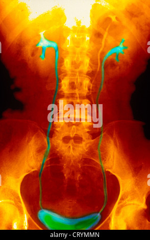 Il sistema urinario, X-RAY RICERCA Foto Stock