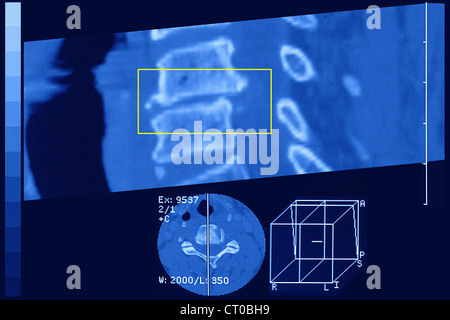 Artrosi cervicale, MRI Foto Stock