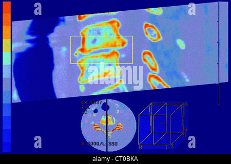 Artrosi cervicale, MRI Foto Stock