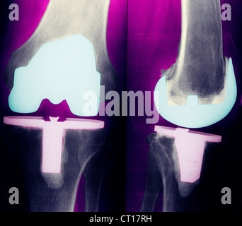 Protesi di ginocchio, RAGGI X Foto Stock