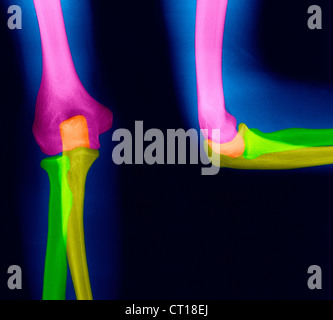 GOMITO, RAGGI X Foto Stock