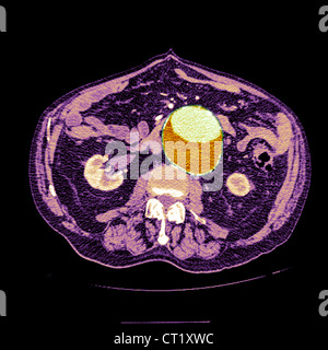 AORTA ADDOMINALE aneurisma, scansione Foto Stock