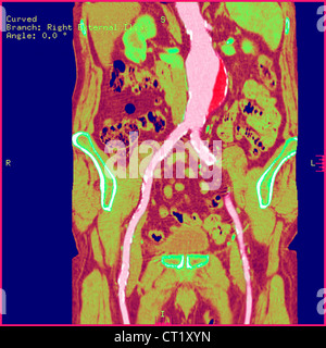 AORTA ADDOMINALE aneurisma, scansione Foto Stock