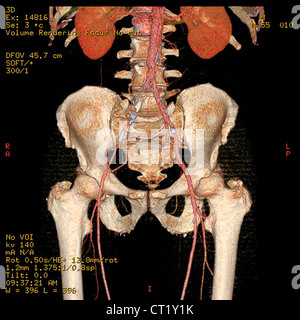 Trombosi iliaca, 3D SCAN Foto Stock