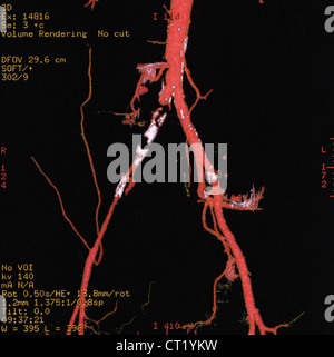 Trombosi iliaca, 3D SCAN Foto Stock