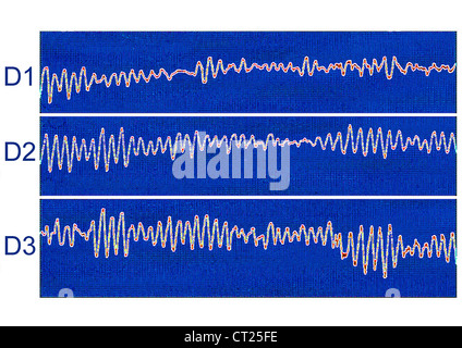 La fibrillazione ventricolare, ECG Foto Stock