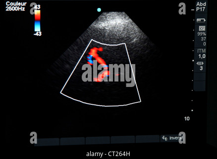 TRANSCRANIAL sonografia doppler Foto Stock