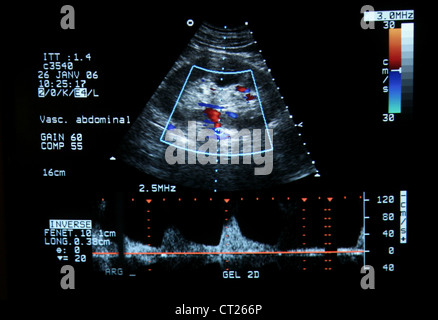 Arteria renale,sonografia doppler Foto Stock