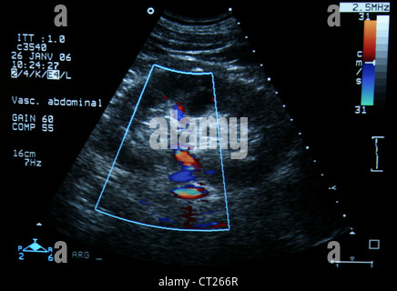 Arteria renale,sonografia doppler Foto Stock