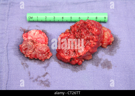 Il meningioma surgery Foto Stock