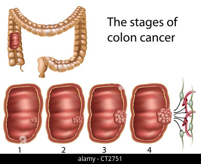 Tumore del colon Foto Stock