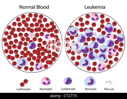 La leucemia rispetto al sangue normale Foto Stock