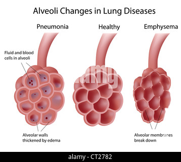 Gli alveoli e le malattie polmonari Foto Stock