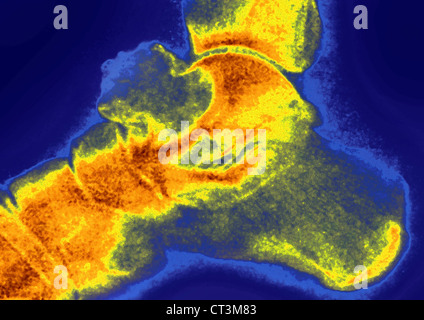 OSTEOCLASTOMA, X-RAY Foto Stock