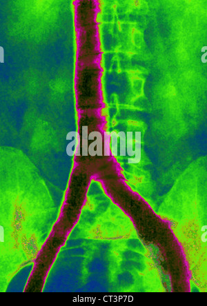 VENA CAVA, angiografia Foto Stock