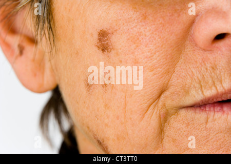 Dermatologia, IL TRATTAMENTO DI PERSONE ANZIANE P. Foto Stock