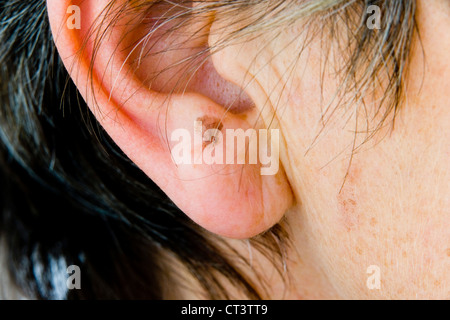 Dermatologia, IL TRATTAMENTO DI PERSONE ANZIANE P. Foto Stock