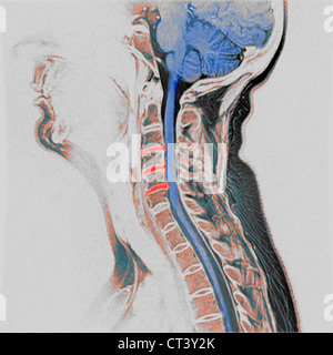 Artrosi cervicale, MRI Foto Stock