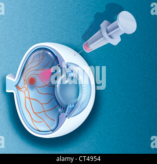 AMD Treatment, illustrazione Foto Stock