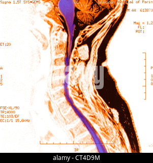 Artrosi cervicale, MRI Foto Stock