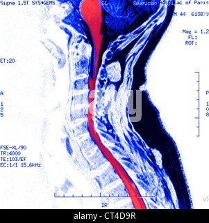 Artrosi cervicale, MRI Foto Stock