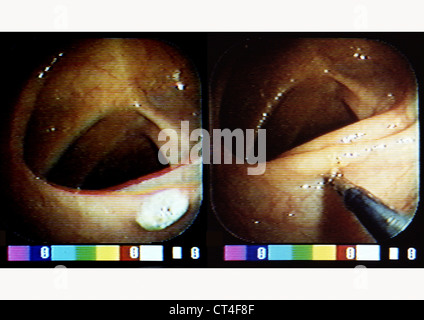 COLON POLIPO DISTACCO, endoscopia Foto Stock