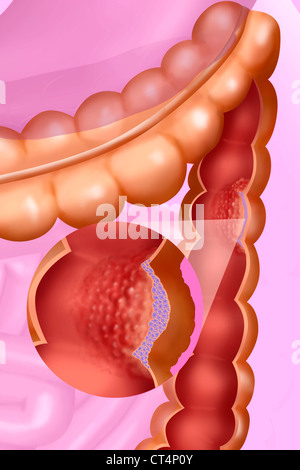 Il cancro del colon, disegno Foto Stock