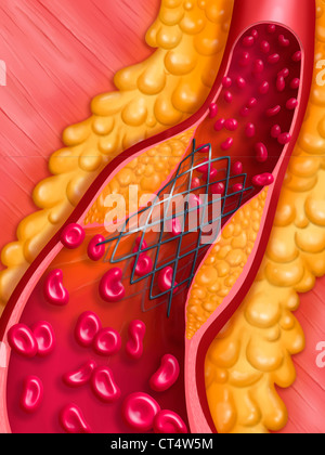 Angioplastica arteriosa, ILLUST. Foto Stock