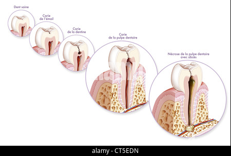 CARIE dentali, disegno Foto Stock