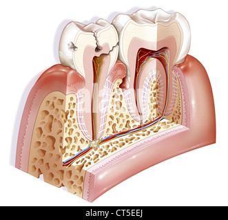 Patologia dentale, disegno Foto Stock