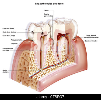 Patologia dentale, disegno Foto Stock