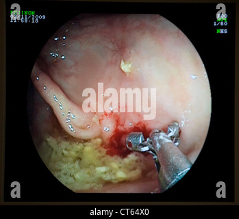 COLON POLIPO DISTACCO, endoscopia Foto Stock