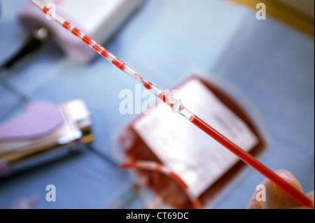 SANGUE DEL CORDONE OMBELICALE Foto Stock