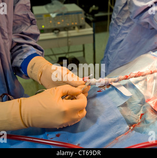 Il sangue del cordone ombelicale campione Foto Stock