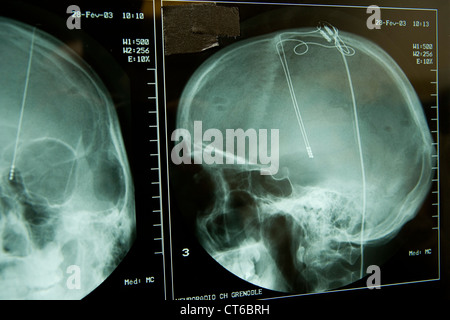 Elettrostimolazione del cervello, X-RAY Foto Stock