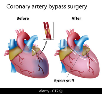 Cuore chirurgia di bypass Foto Stock