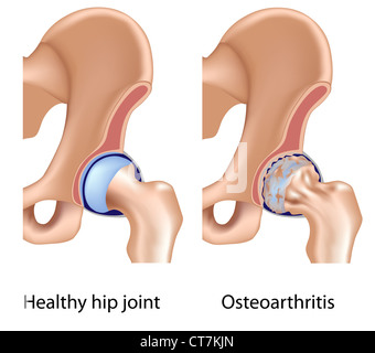 Artrosi dell'anca Foto Stock