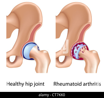 Artrite reumatoide di anca Foto Stock